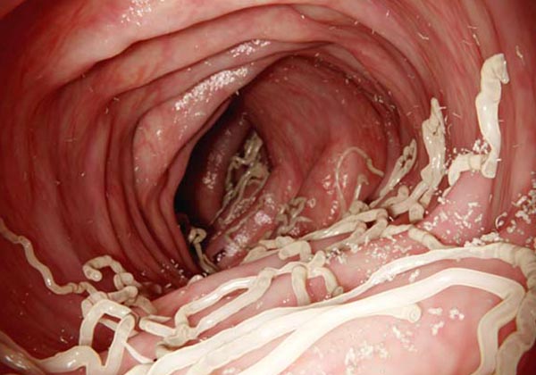 raccoon roundworm in humans